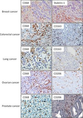 Tumor-Associated Macrophages in Human Breast, Colorectal, Lung, Ovarian and Prostate Cancers